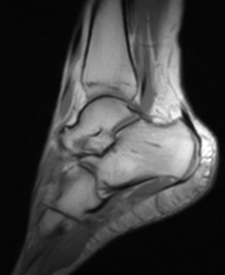 Normal calcaneus